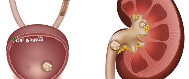 مزيج سحري يدمر حصوات الكلى بدون جراحة وينضف المسالك البولية تمامًا