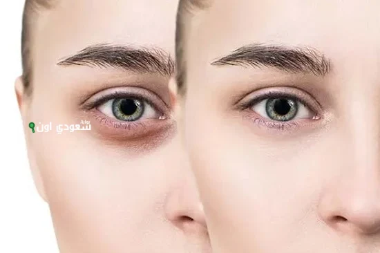 وصفة جل الصبار للهالات السوداء