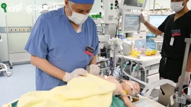 نجاح عملية فصل التوأم الطفيلي المصري محمد عبدالرحمن