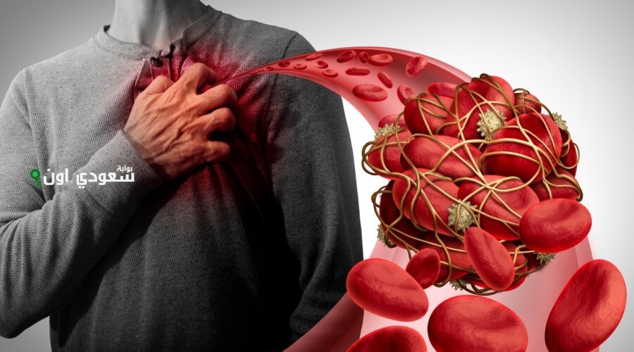 شوية مكونات موجودة في كل بيت هتحمي قلبك من الجلطات وتحافظ على صحتك سنين قدام