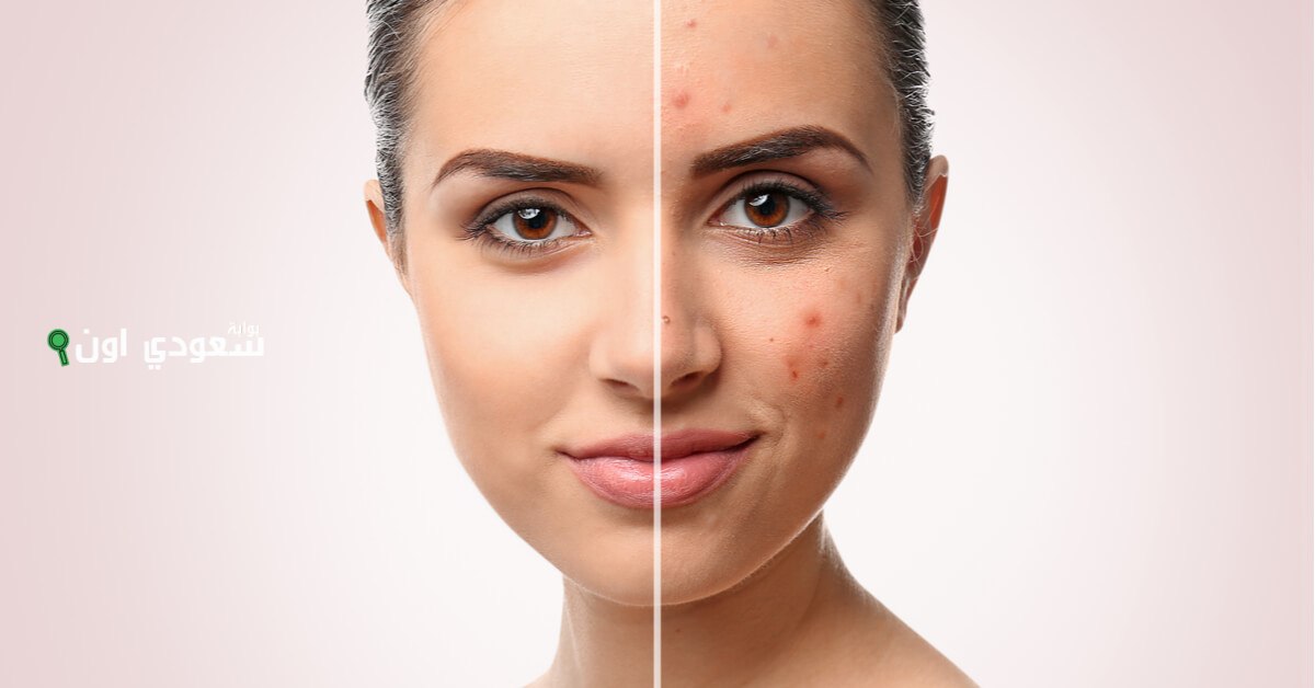 وصفات طبيعية للتخلص من آثار الحبوب