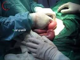 انقاذ حاجا أفغانيا من انسداد الأمعاء