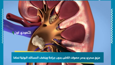 مزيج سحري يدمر حصوات الكلى بدون جراحة وينضف المسالك البولية تمامًا