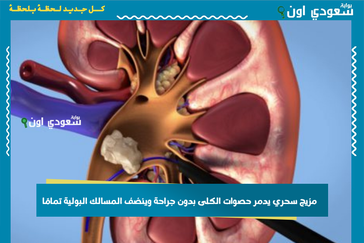 على طريقة ستي وستك.. مزيج سحري يدمر حصوات الكلى بدون جراحة وينضف المسالك البولية تمامًا