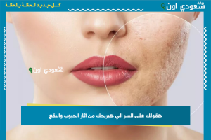 وصفات طبيعية للتخلص من آثار الحبوب