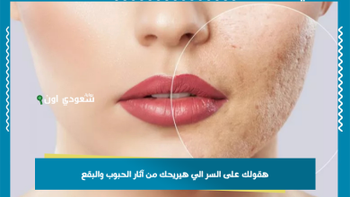 وصفات طبيعية للتخلص من آثار الحبوب