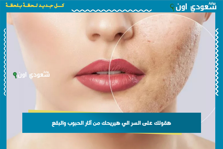 هقولك على السر الي هيريحك من آثار الحبوب والبقع.. هتبصي لنفسك في المراية مبسوطة