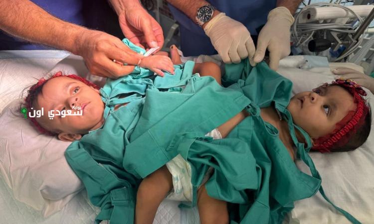 نجاح عملية فصل التوأم السعودي الملتصق يارا ولارا بشكل متميز