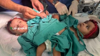 بدء عملية فصل التوأم الملتصق السعودي يارا ولارا