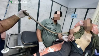 فريق جراحي ينقذ مريضاً بعد اختراق سيخ حديدي لذراعه