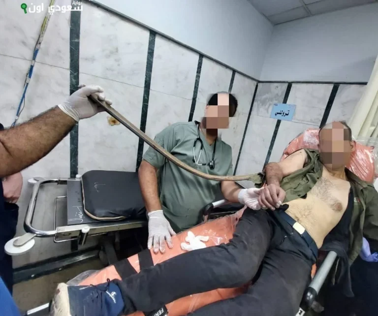 فريق جراحي ينقذ مريضاً بعد اختراق سيخ حديدي لذراعه