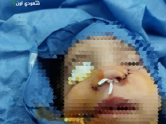جراحة أنف الأطفال