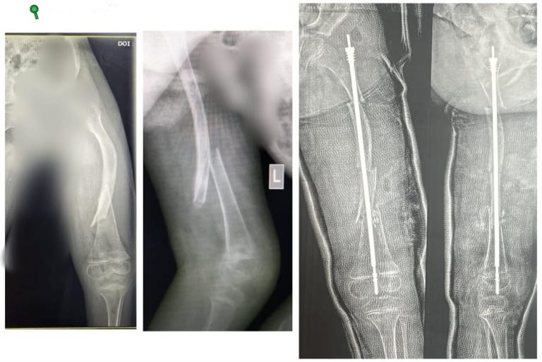 جاح عملية جراحة عظام لطفلة بمرض العظام الزجاجية بسوهاج