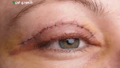 15 جراحة لعلاج مشاكل العيون