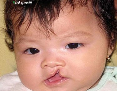 نجاح أول عملية ترميم شفة أرنبية لطفلة