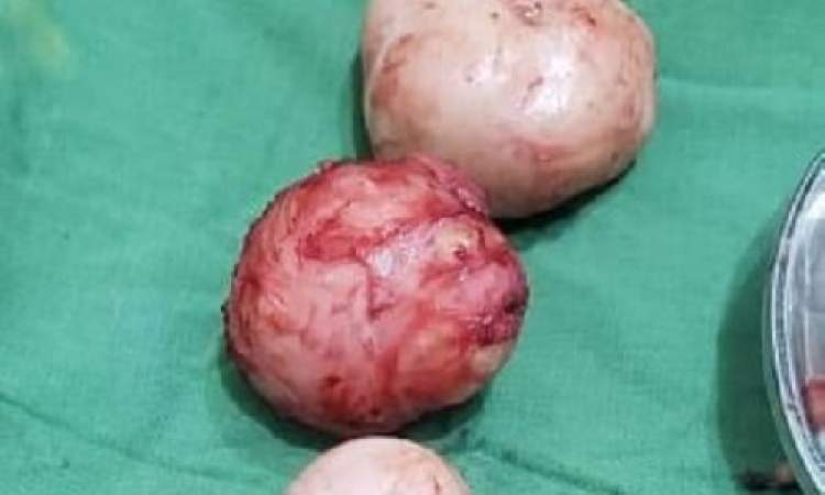 استئصال ورم ليفي يزن 2.6 كيلوجرام